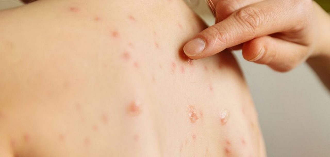 A new case of measles, confirmed in the Republic of Moldova. It is the second this year