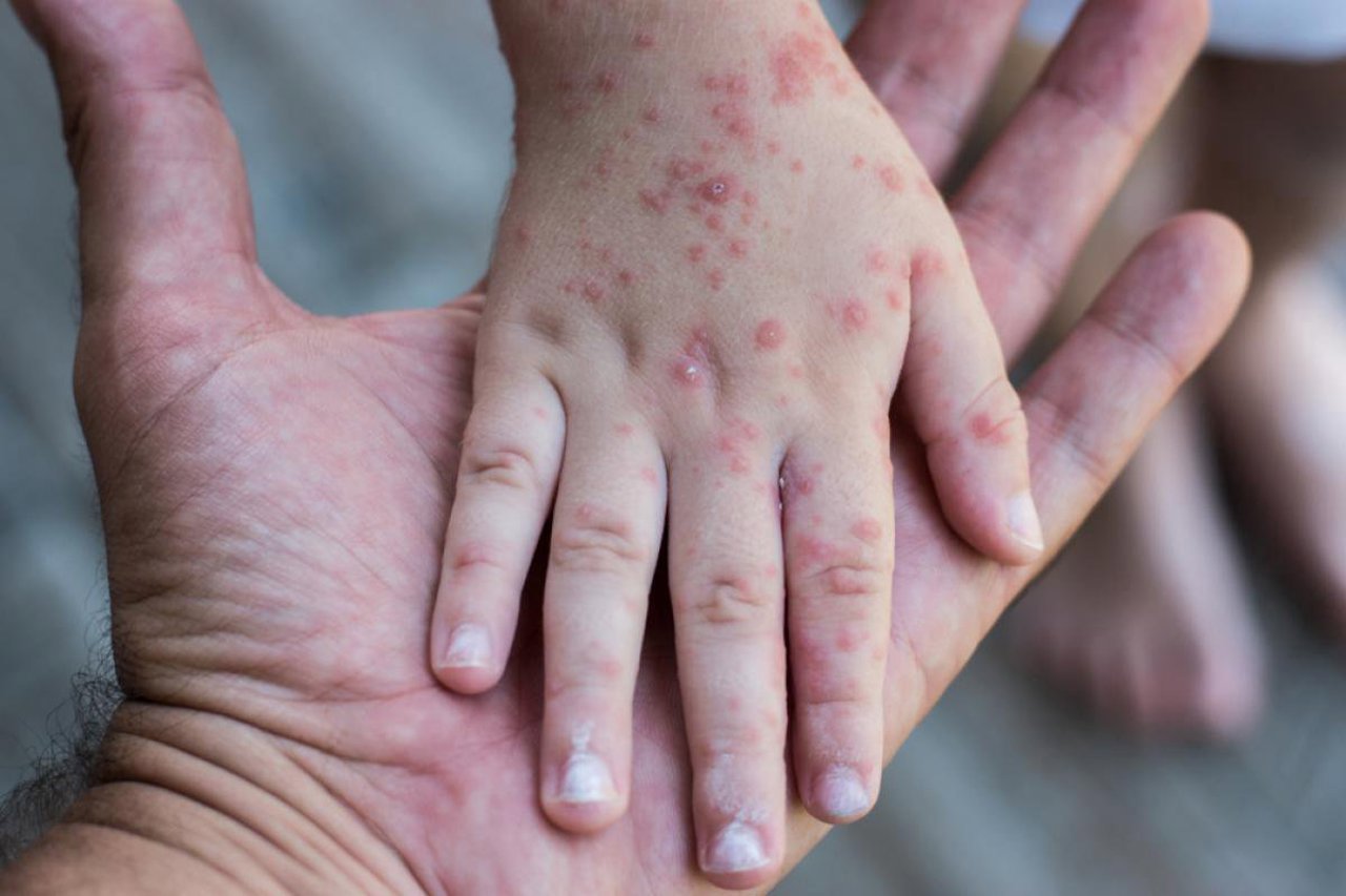 Four measles cases confirmed in Chisinau