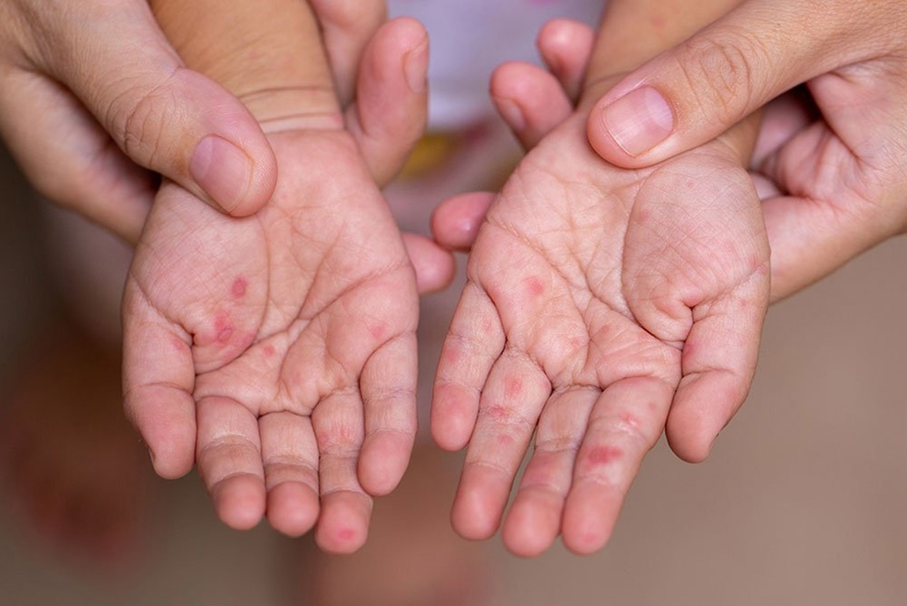 В Кишиневе, в одной из семей, зарегистрирован случай заражения корью 