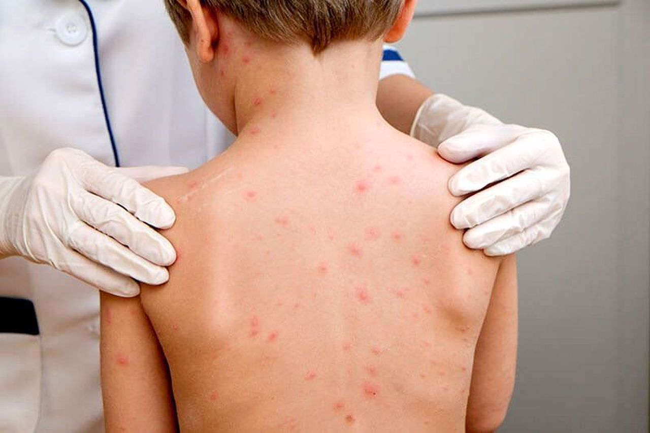 Chisinau: Measles outbreak in a family with five children