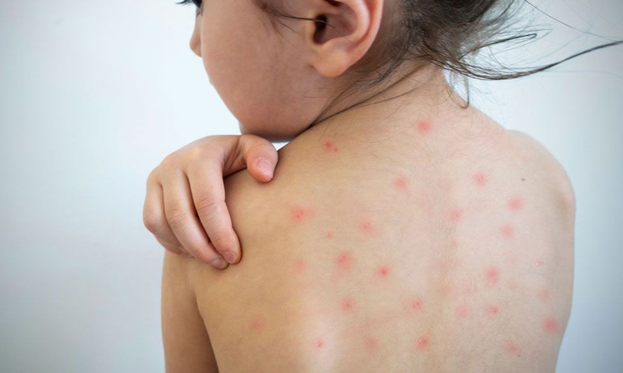 A new case of measles was registered in the Republic of Moldova