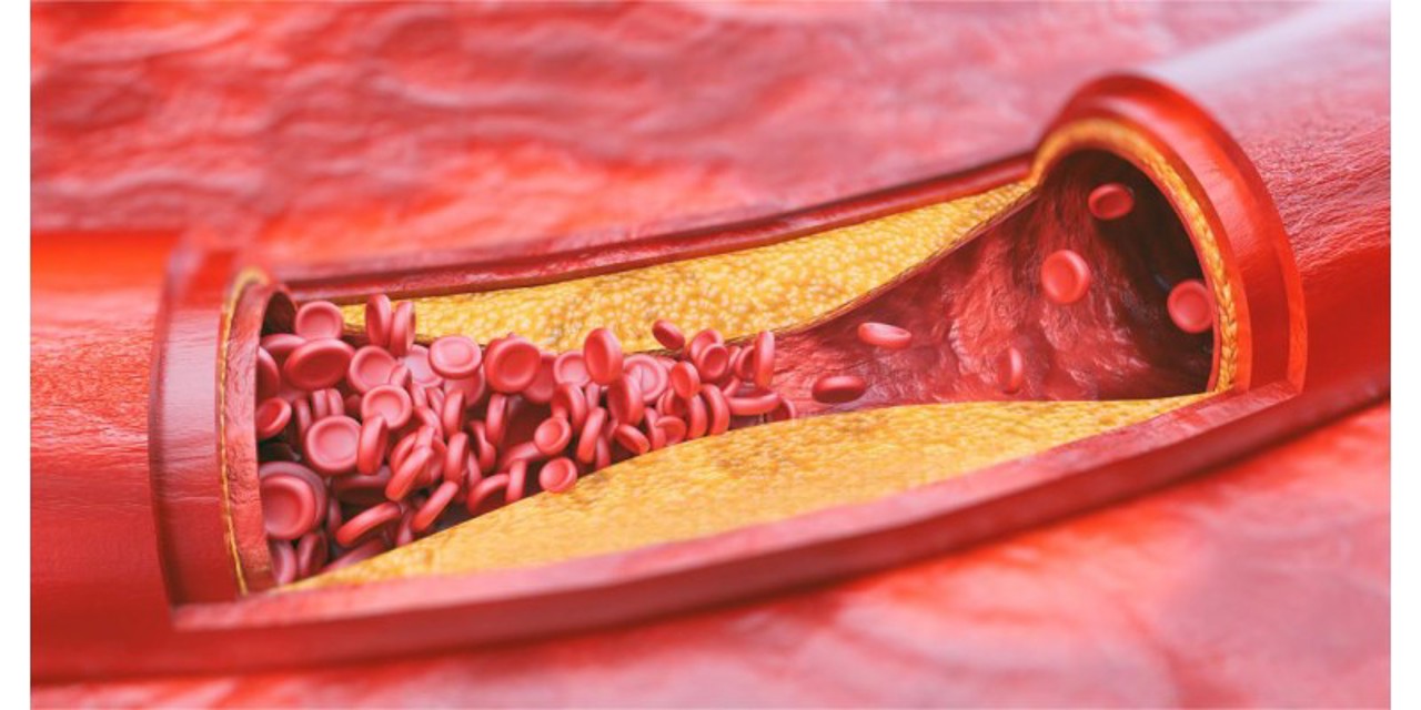 Doctorul familiei//Descoperirea microplasticului în plăcile aterosclerotice
