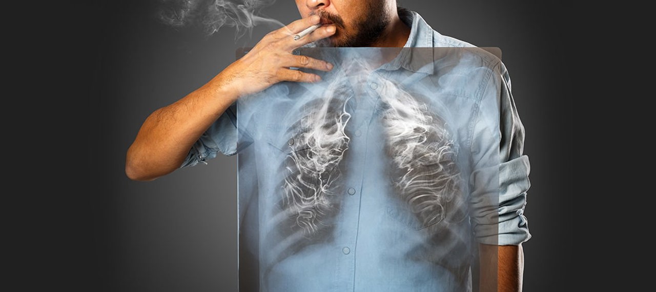 „Nu există doză sigură de tutun”: Fumatul sporește riscul de infarct, accident vascular cerebral și cancer 