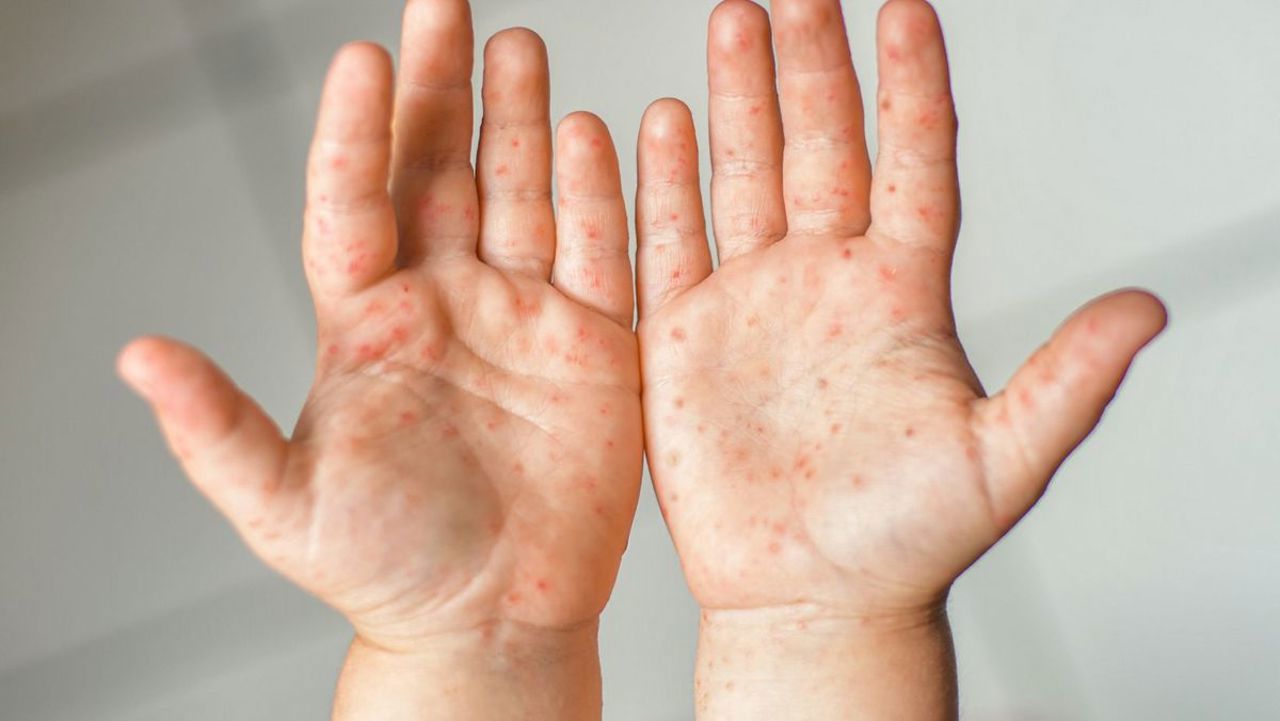 New measles cases in Chișinău. Vladimir Bolocan: Children remain unvaccinated