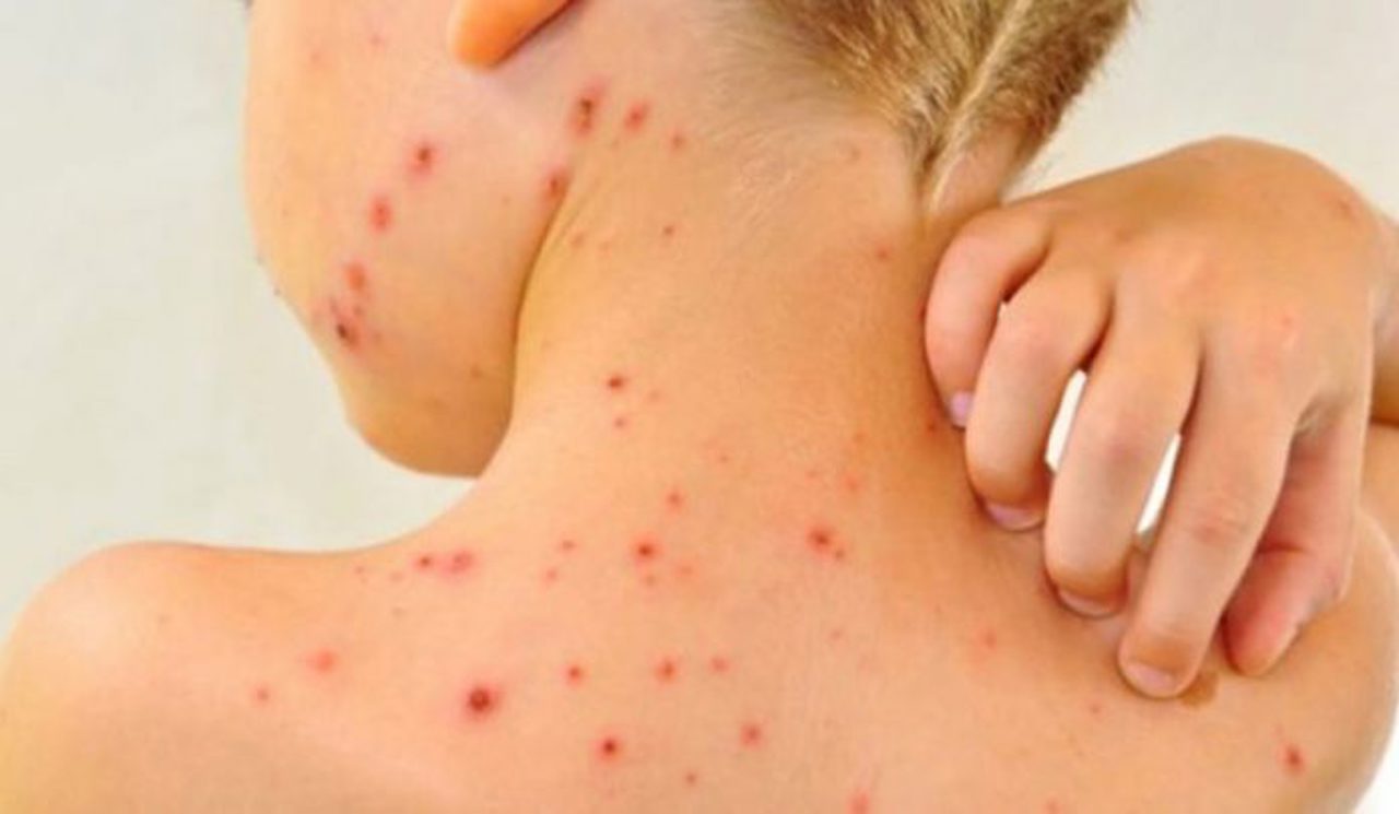 Seven cases of measles reported since the start of the year
