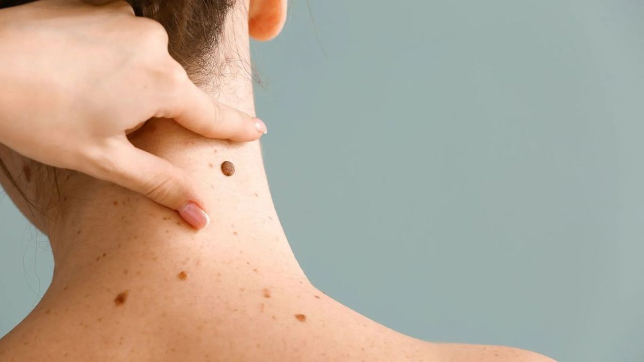 Alunițele nu trebuie ignorate. Dermatolog: Controlul preventiv depistează problemele din timp