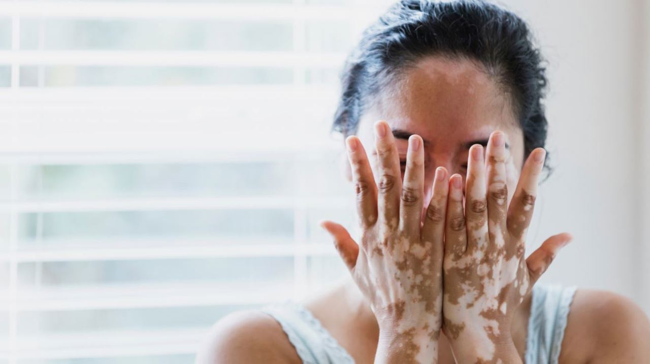 Semnalele transmise de piele: Cum se manifestă vitiligo și de ce pacienții au nevoie de suport emoțional