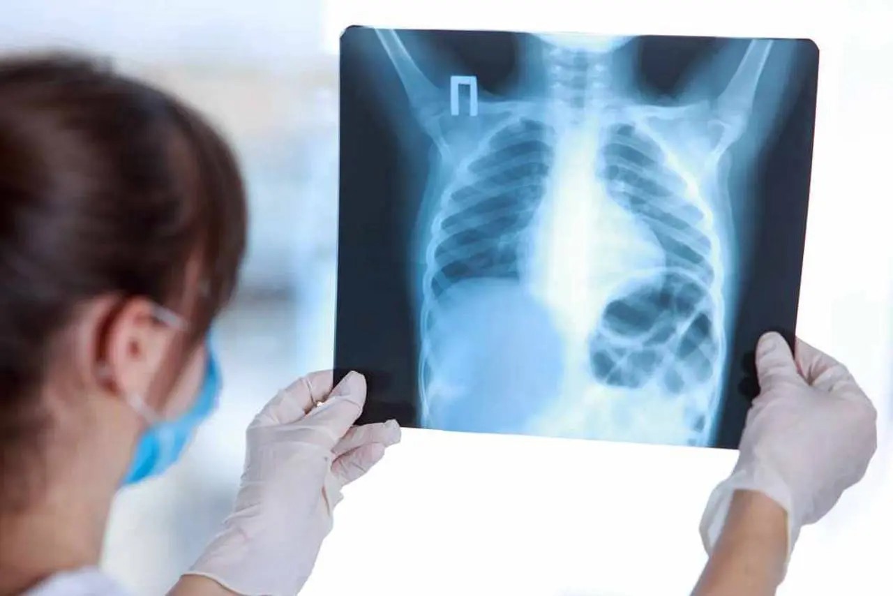 Cinci cazuri de tuberculoză, inclusiv la un copil, confirmate în capitală 