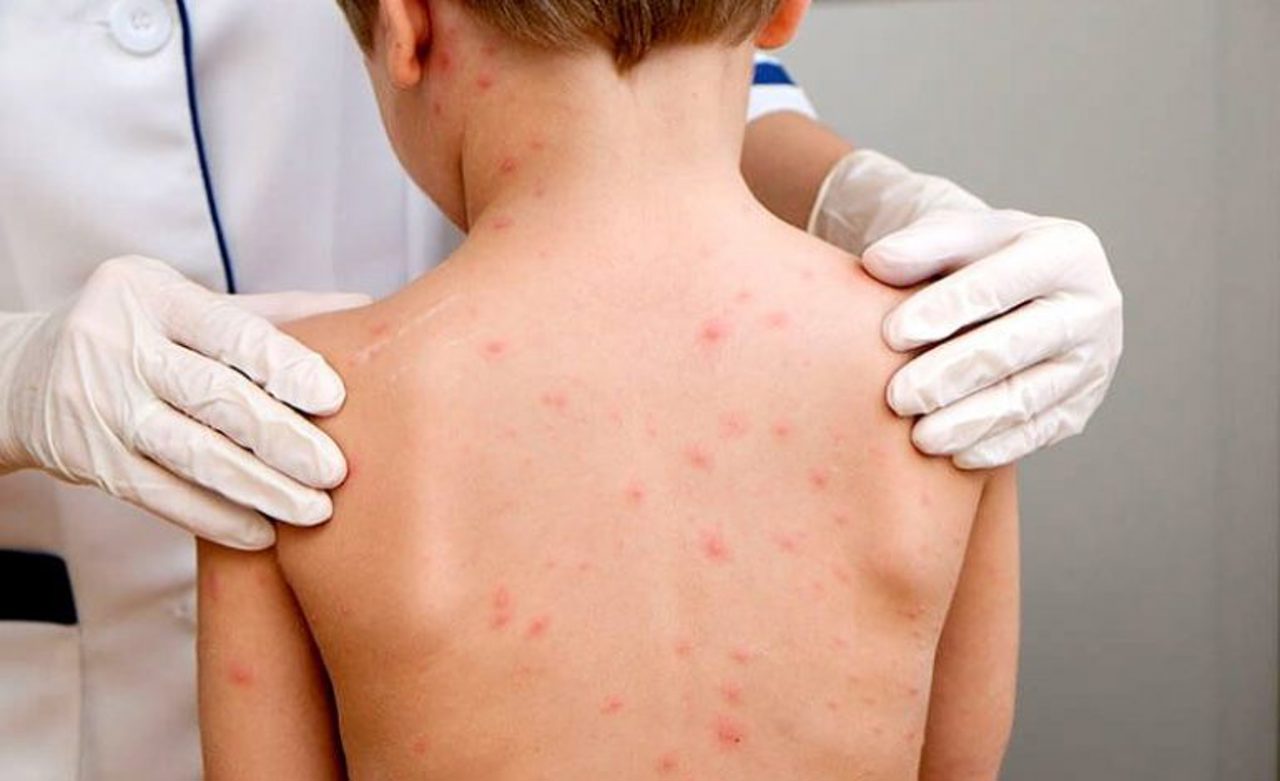 Peste 70 de cazuri de rujeolă în Bulgaria: copiii, cei mai afectați